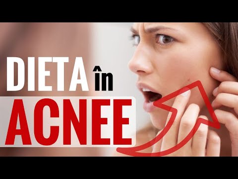 ACNEEA – ce să mănânci ca să o previi