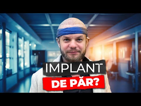 2 Zile de Implant de Păr | Ce s-a Intamplat si Cum m-am Simtit!